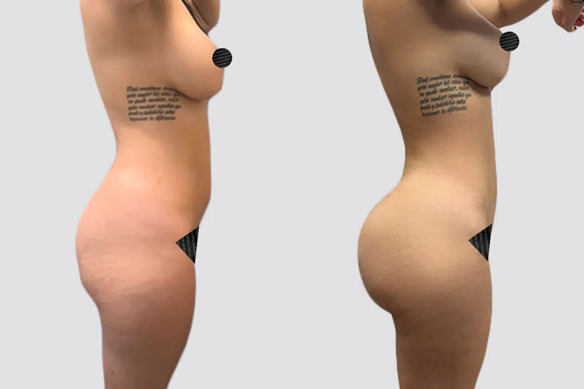 Bbl result at Mia Aesthetics