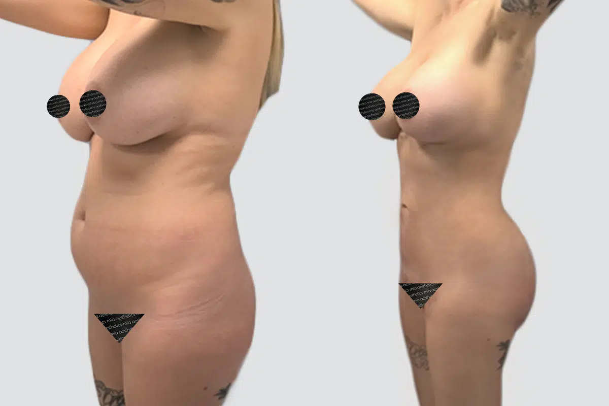Bbl result at Mia Aesthetics