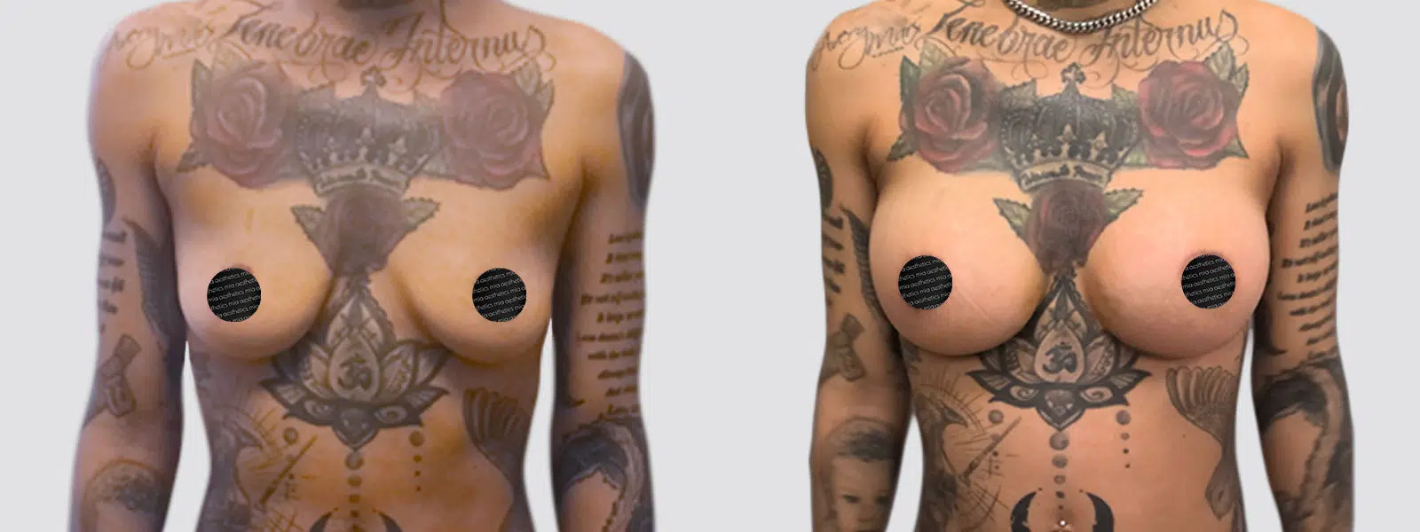 Breast Augmentation result at Mia Aesthetics