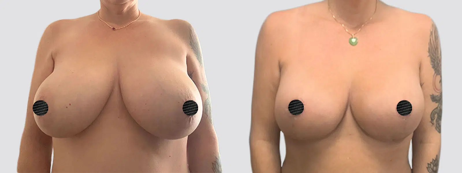 Breast Reduction result at Mia Aesthetics