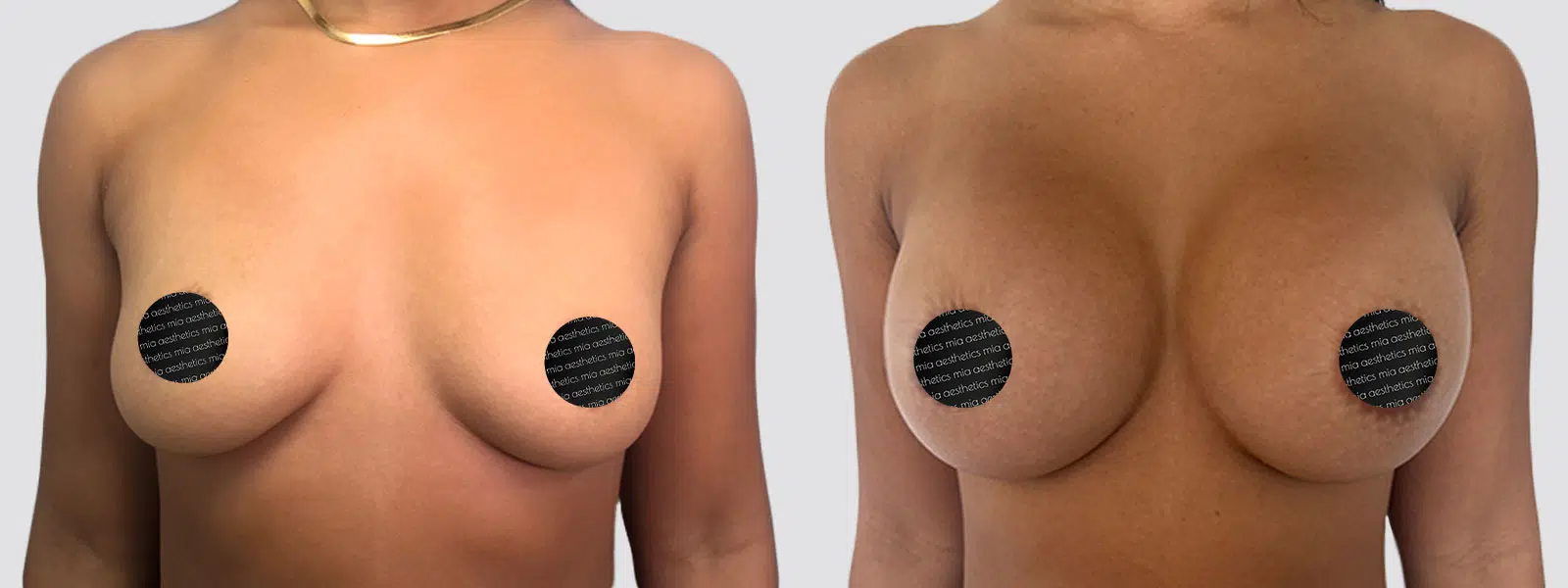 Breast Augmentation result at Mia Aesthetics