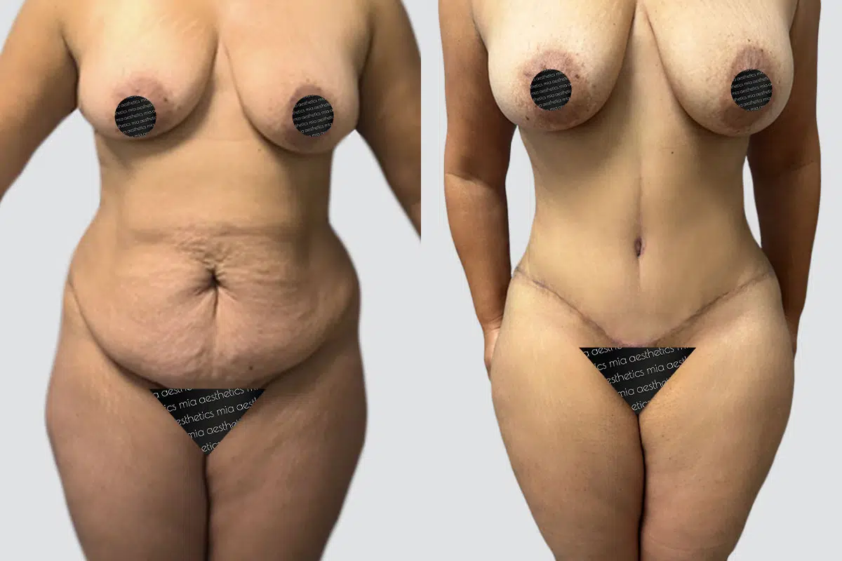 Tummy Tuck result at Mia Aesthetics