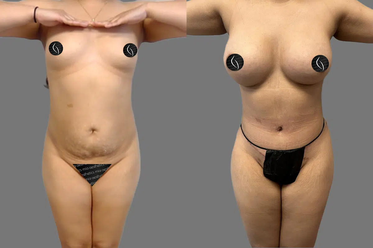 Mommy Makeover result at Mia Aesthetics