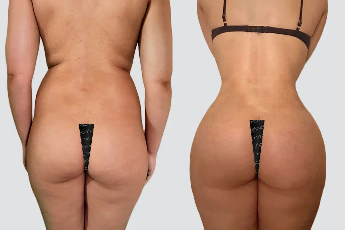Bbl result at Mia Aesthetics