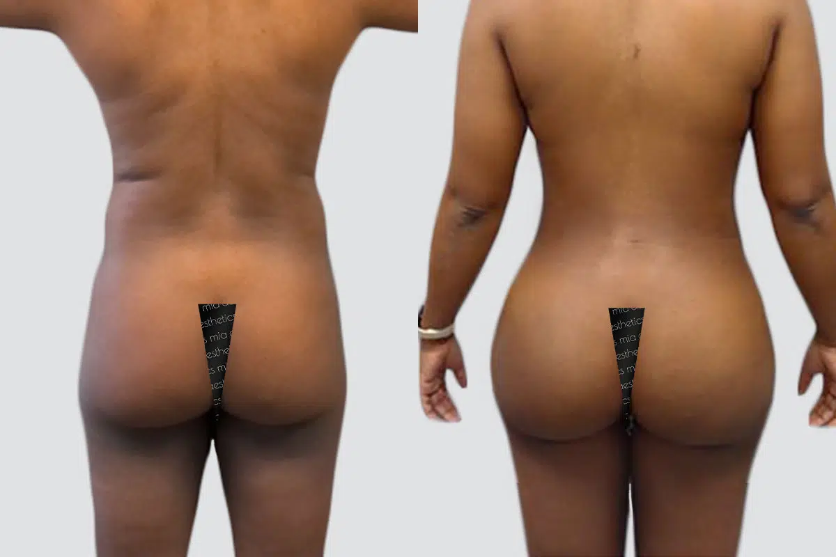 Bbl result at Mia Aesthetics