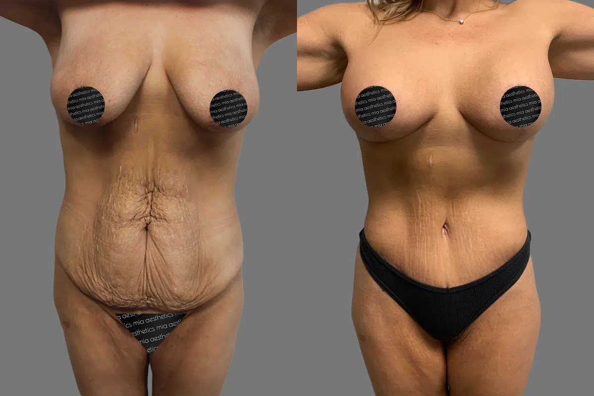 Mommy Makeover result at Mia Aesthetics