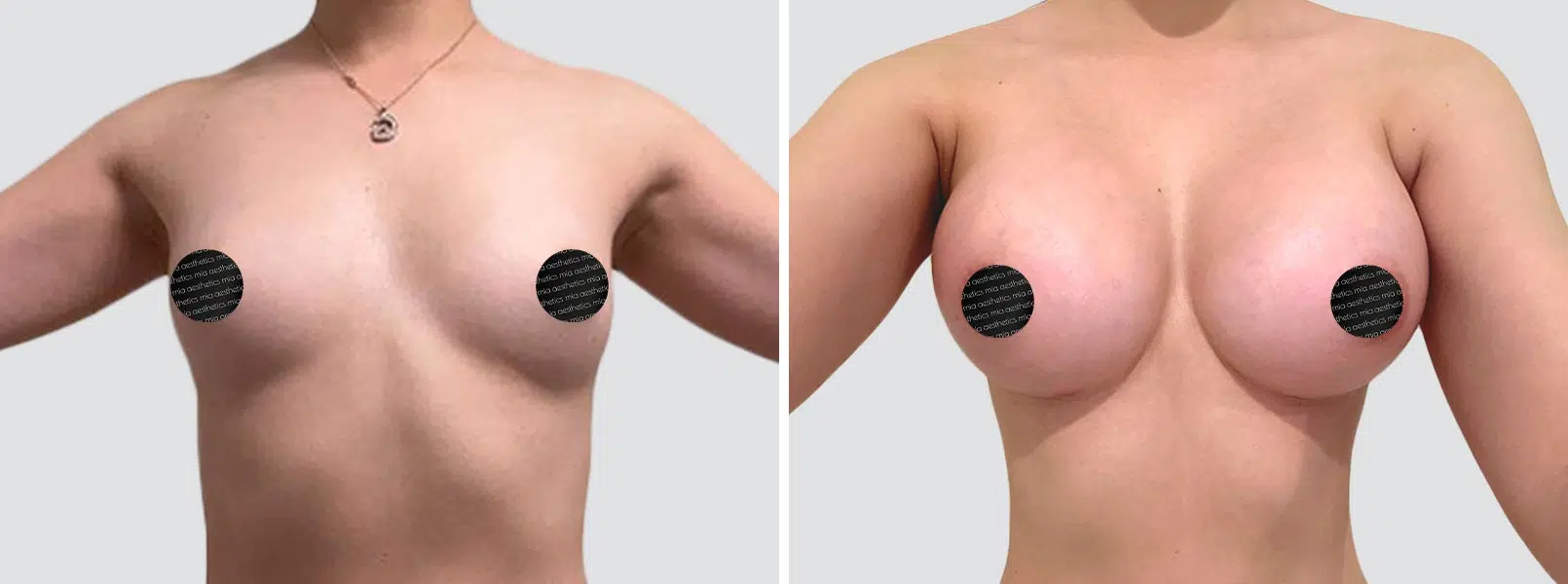 Breast Augmentation result at Mia Aesthetics