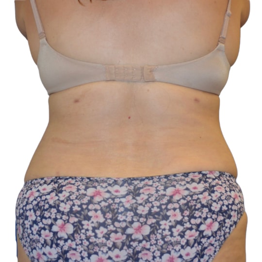 A result from TrueCare Cosmetic Surgery Irvine - Babak Farzaneh MD