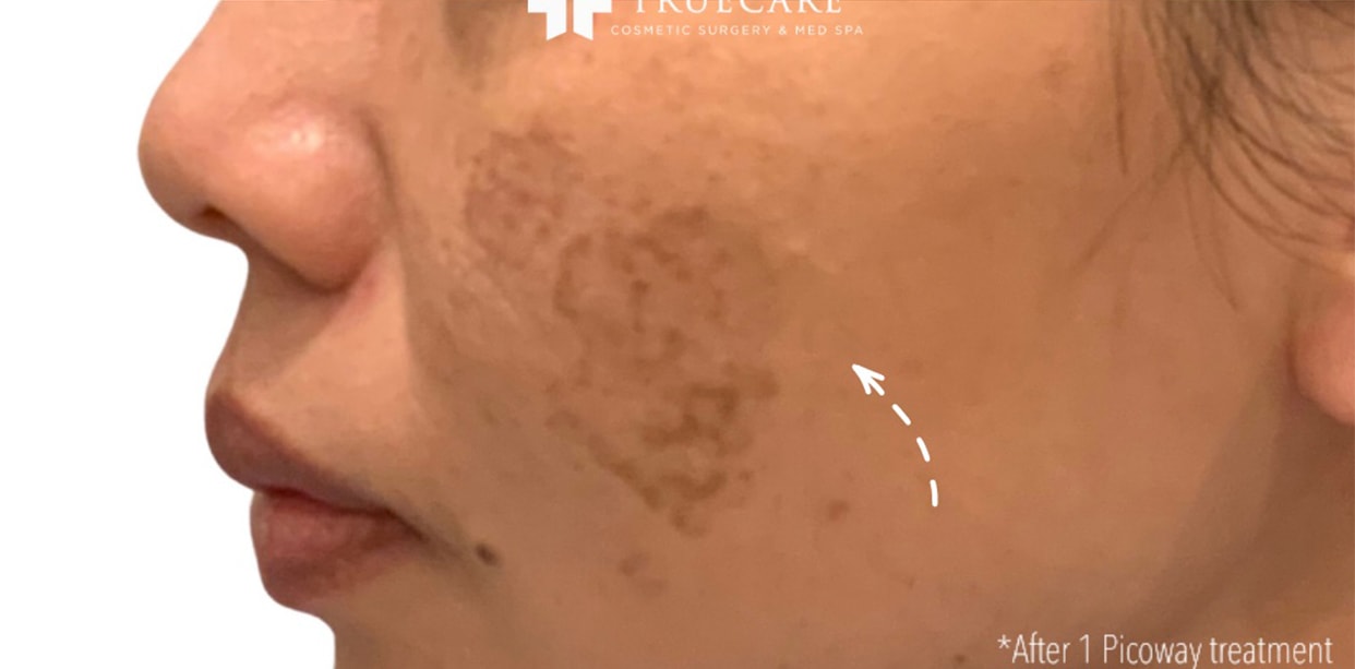 A result from TrueCare Cosmetic Surgery Irvine - Babak Farzaneh MD