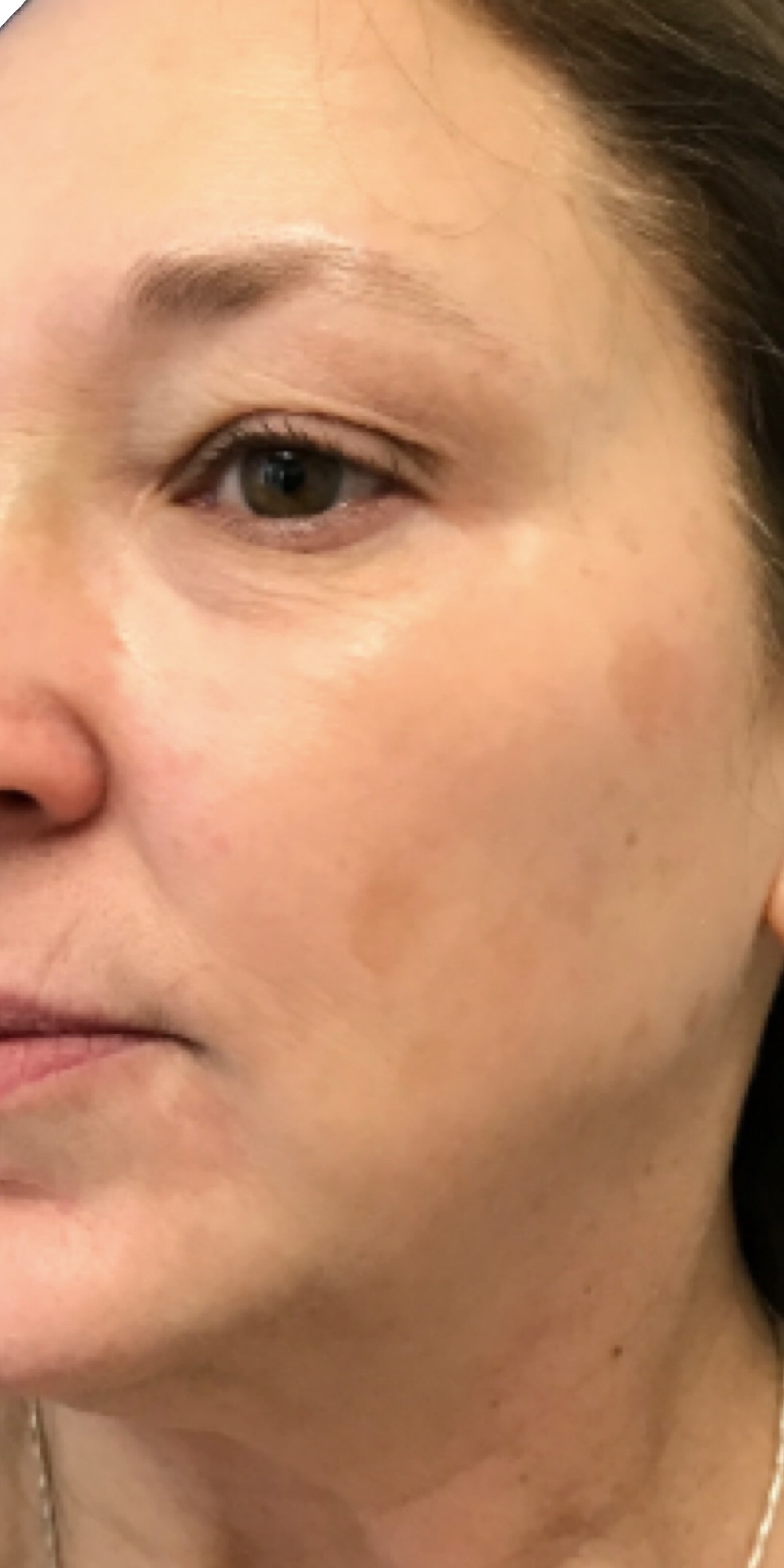 A result from TrueCare Cosmetic Surgery Irvine - Babak Farzaneh MD