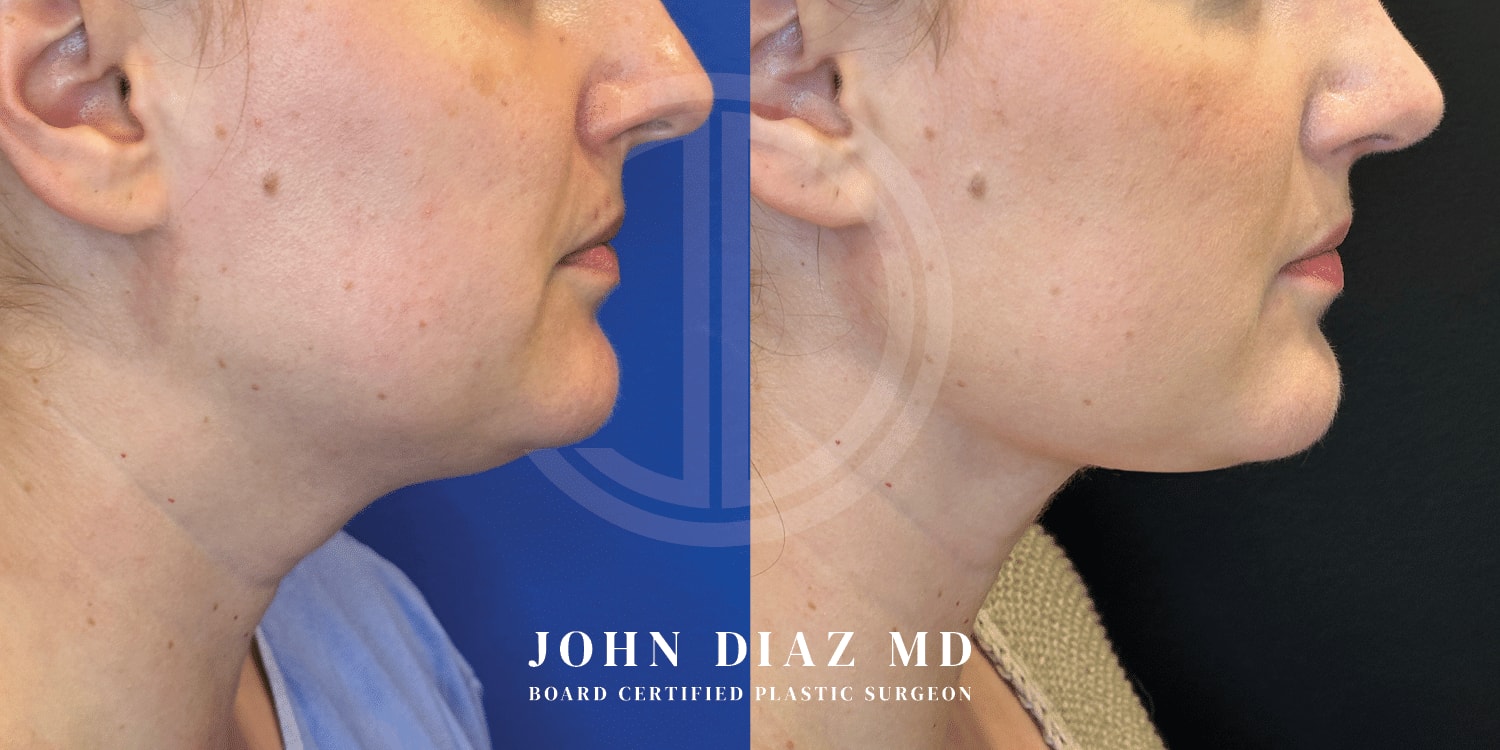 A result from Dr. John Diaz Plastic Surgery