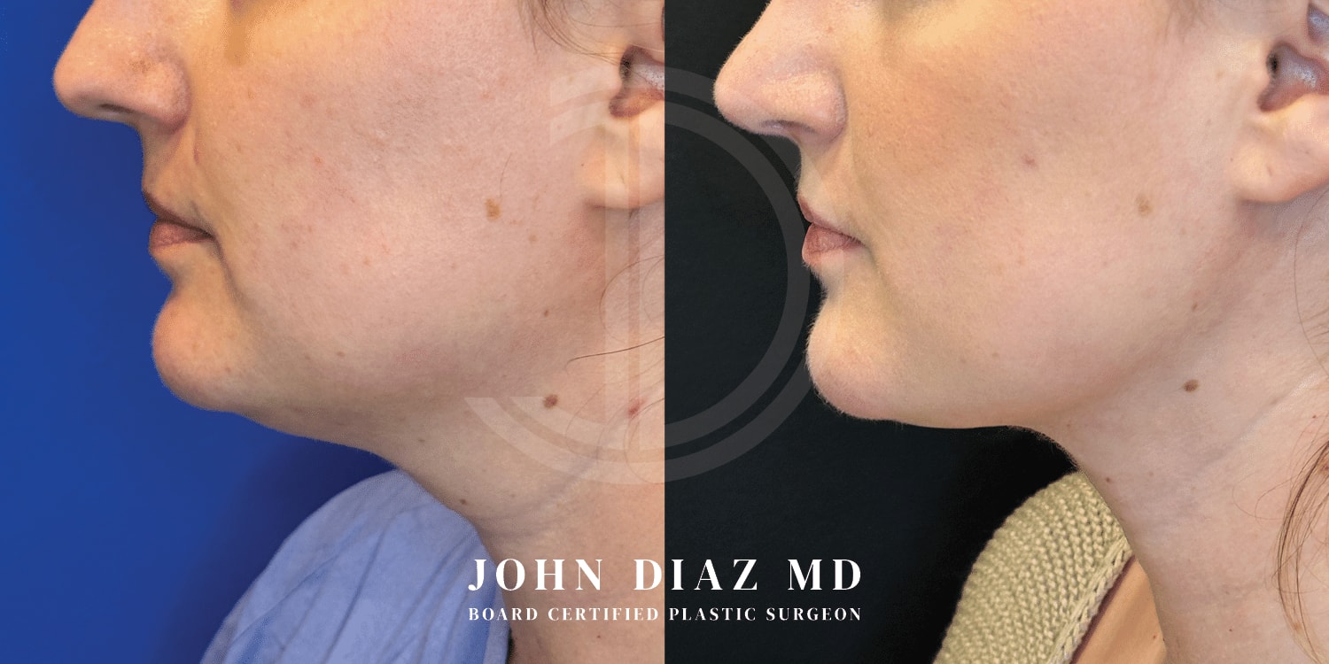 A result from Dr. John Diaz Plastic Surgery