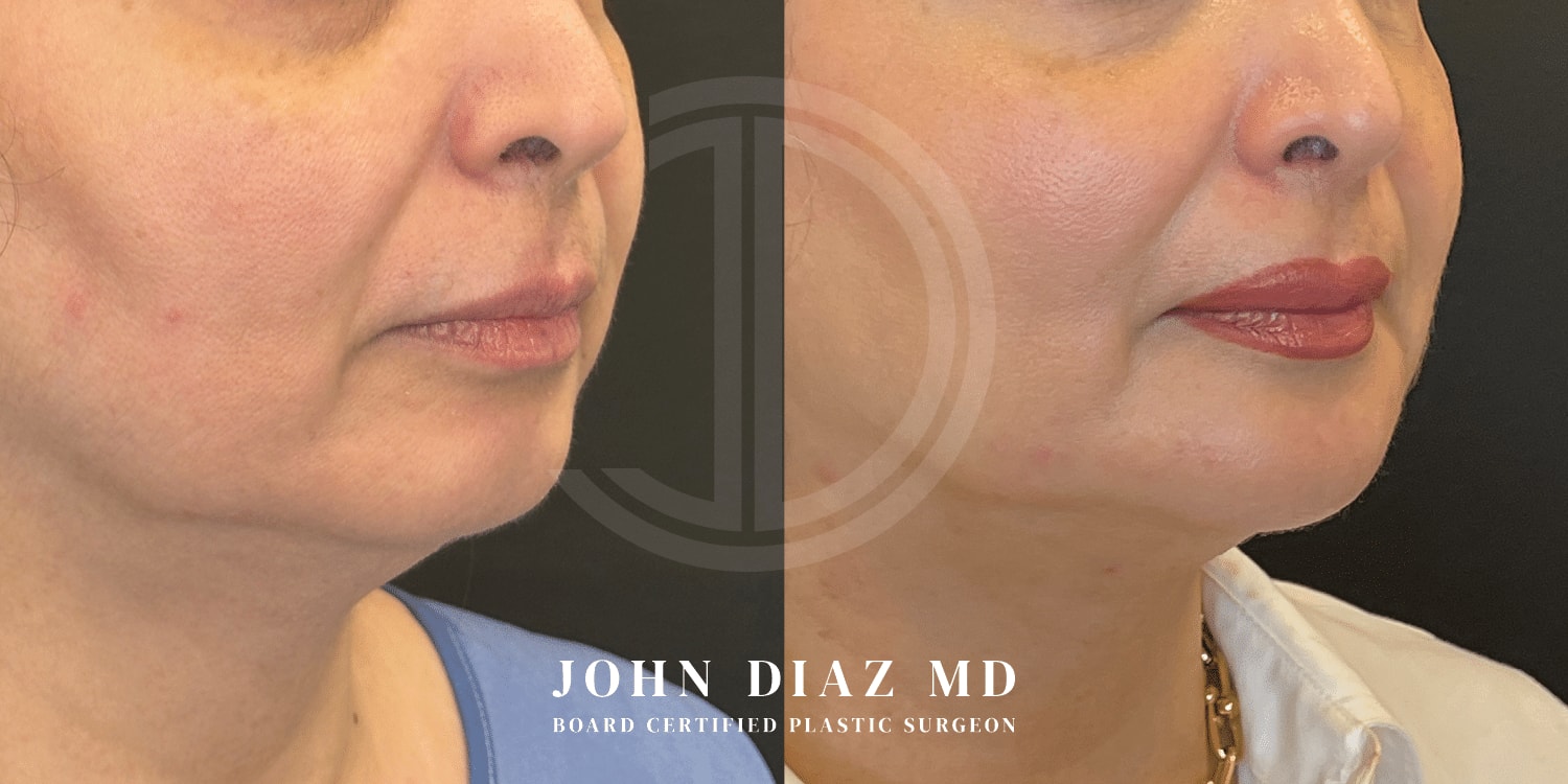 A result from Dr. John Diaz Plastic Surgery
