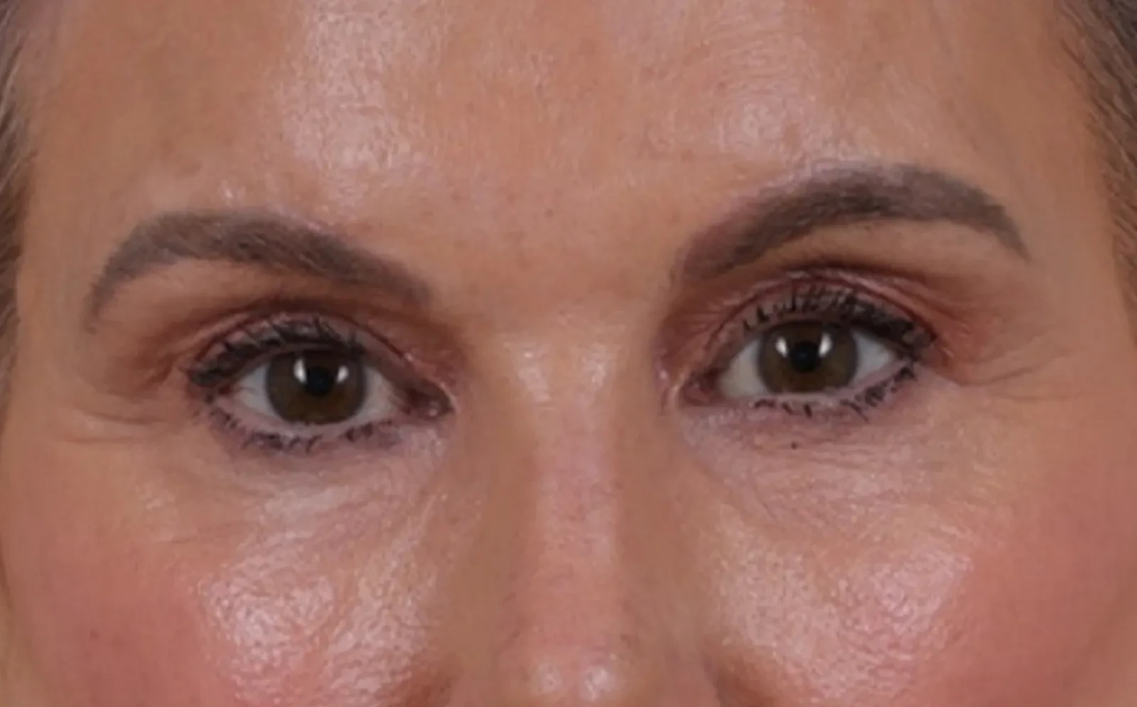 A result from Cheng Plastic Surgery