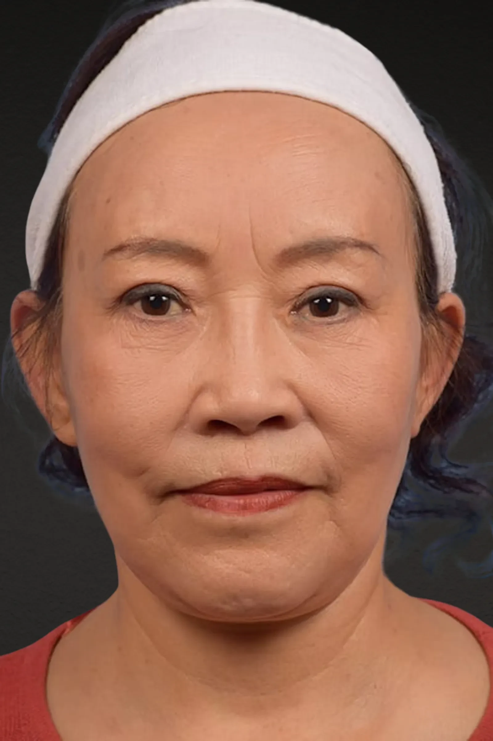 A result from Cheng Plastic Surgery