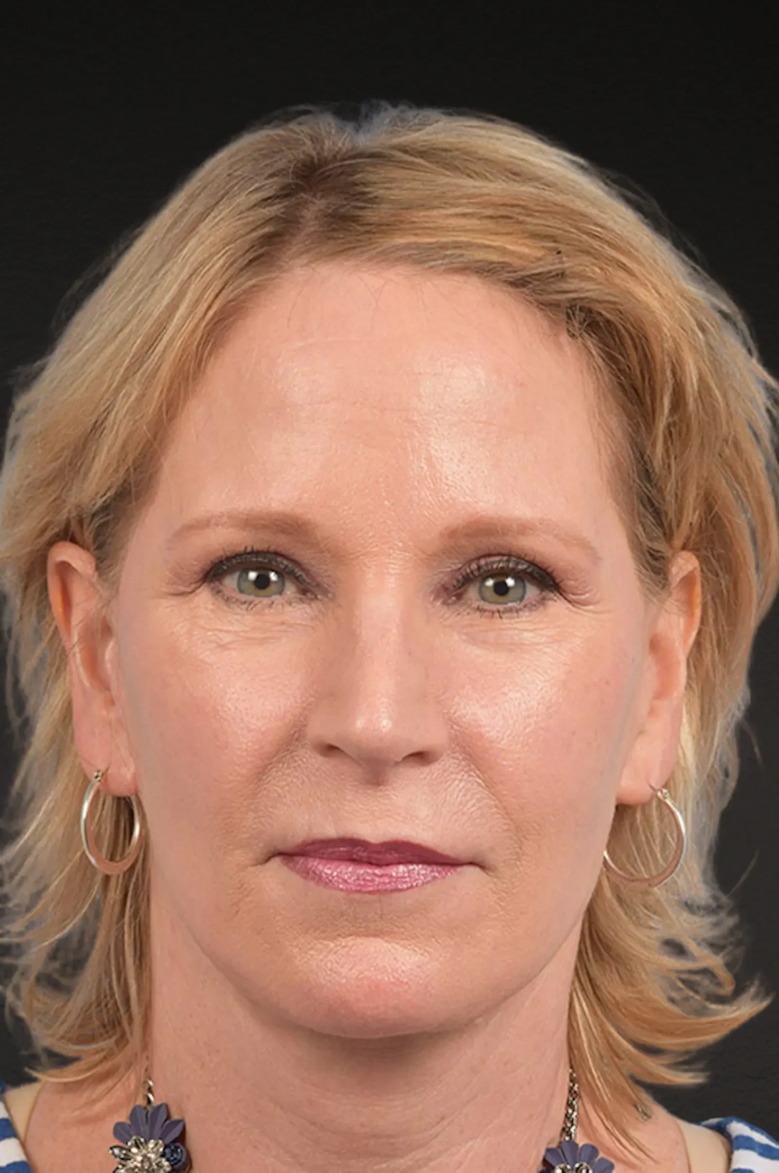 A result from Cheng Plastic Surgery