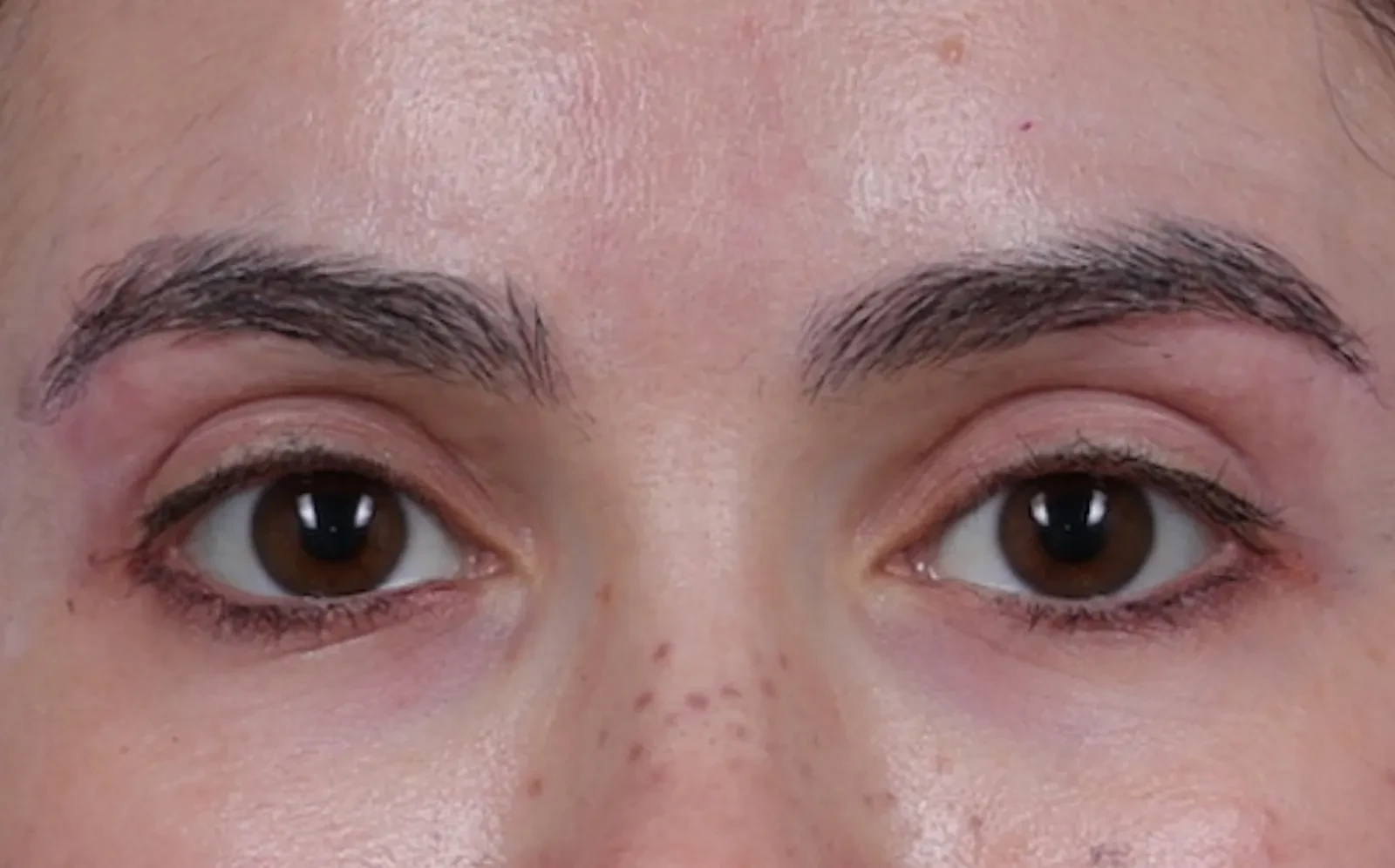 A result from Cheng Plastic Surgery