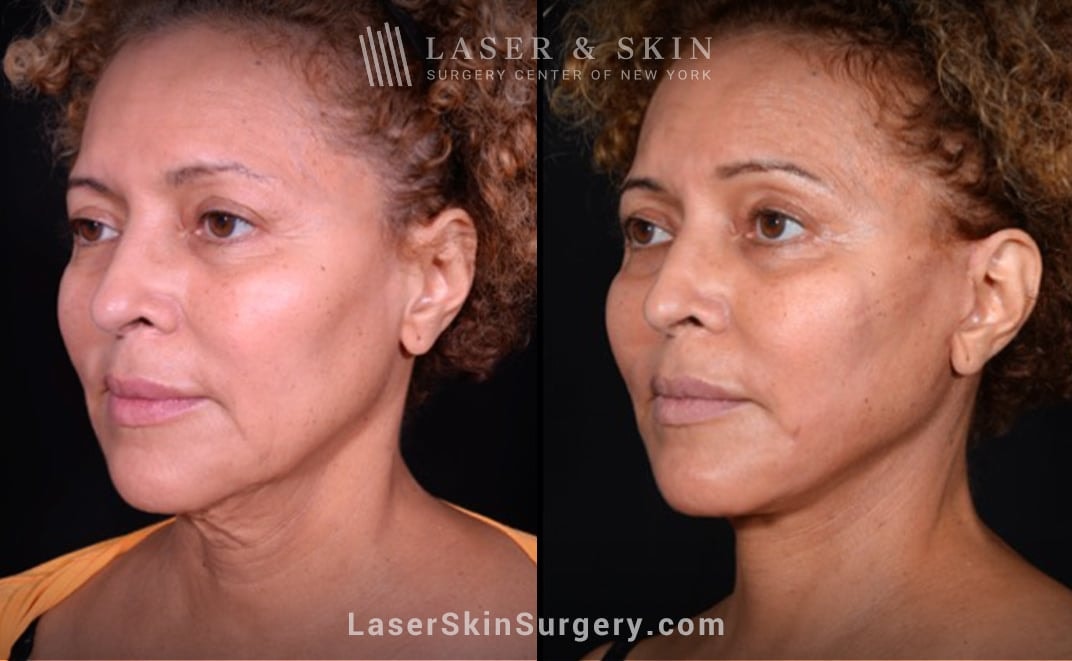 A result from Dr. Lloyd Hoffman