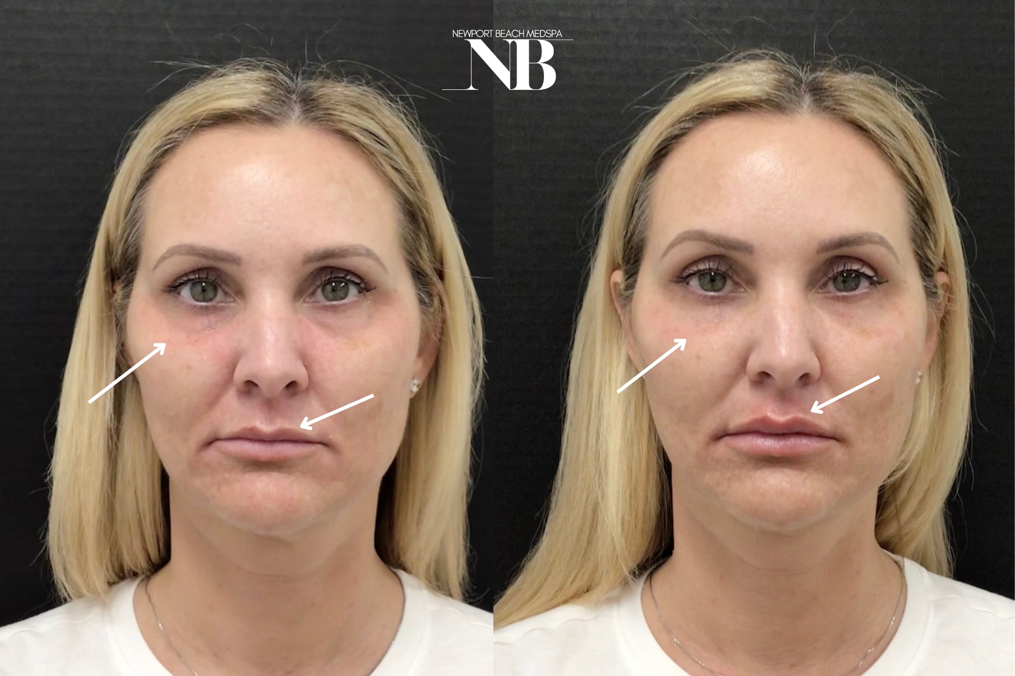 A result from Newport Beach MedSpa