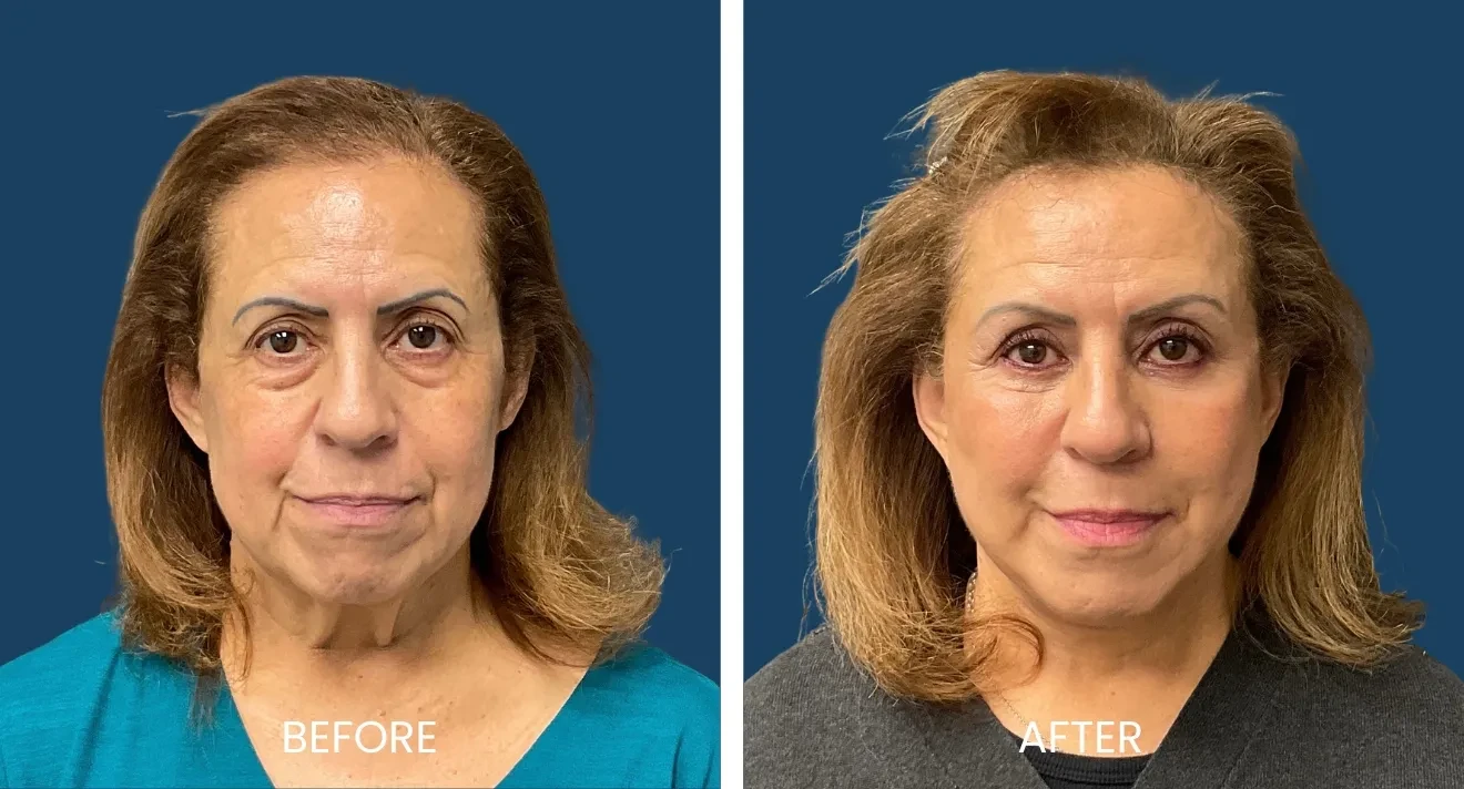 A result from Plano Plastic Surgery — MedSpa