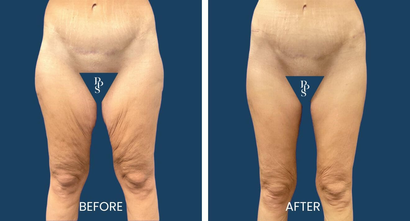 A result from Plano Plastic Surgery — MedSpa