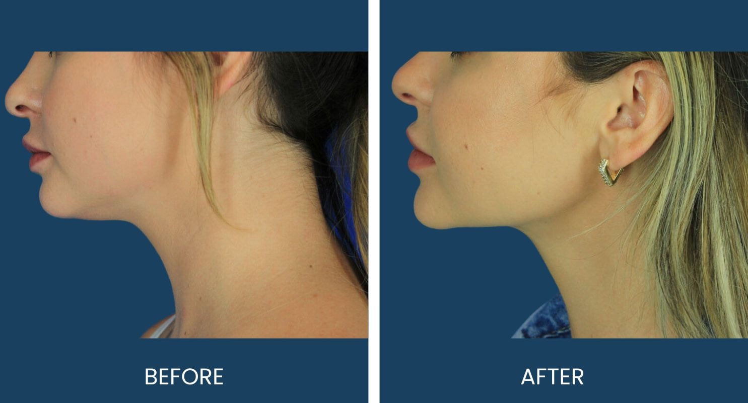 A result from Plano Plastic Surgery — MedSpa