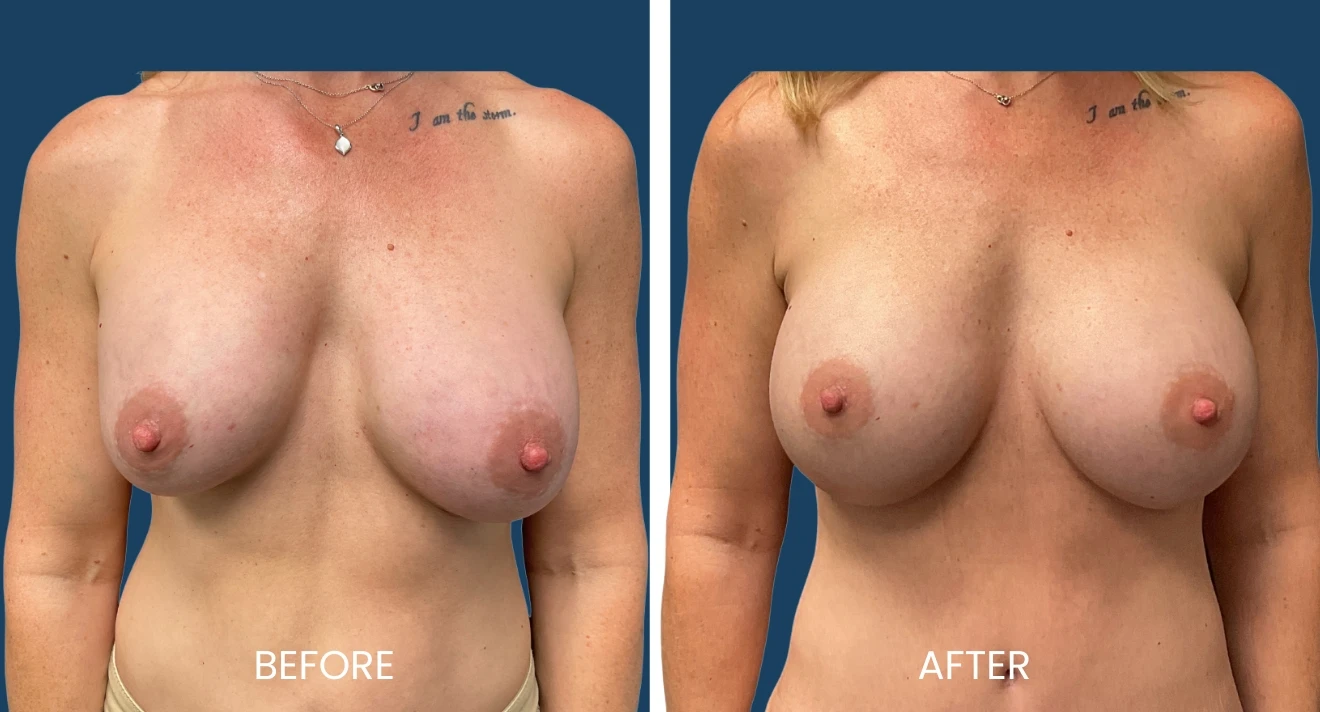 A result from Plano Plastic Surgery — MedSpa
