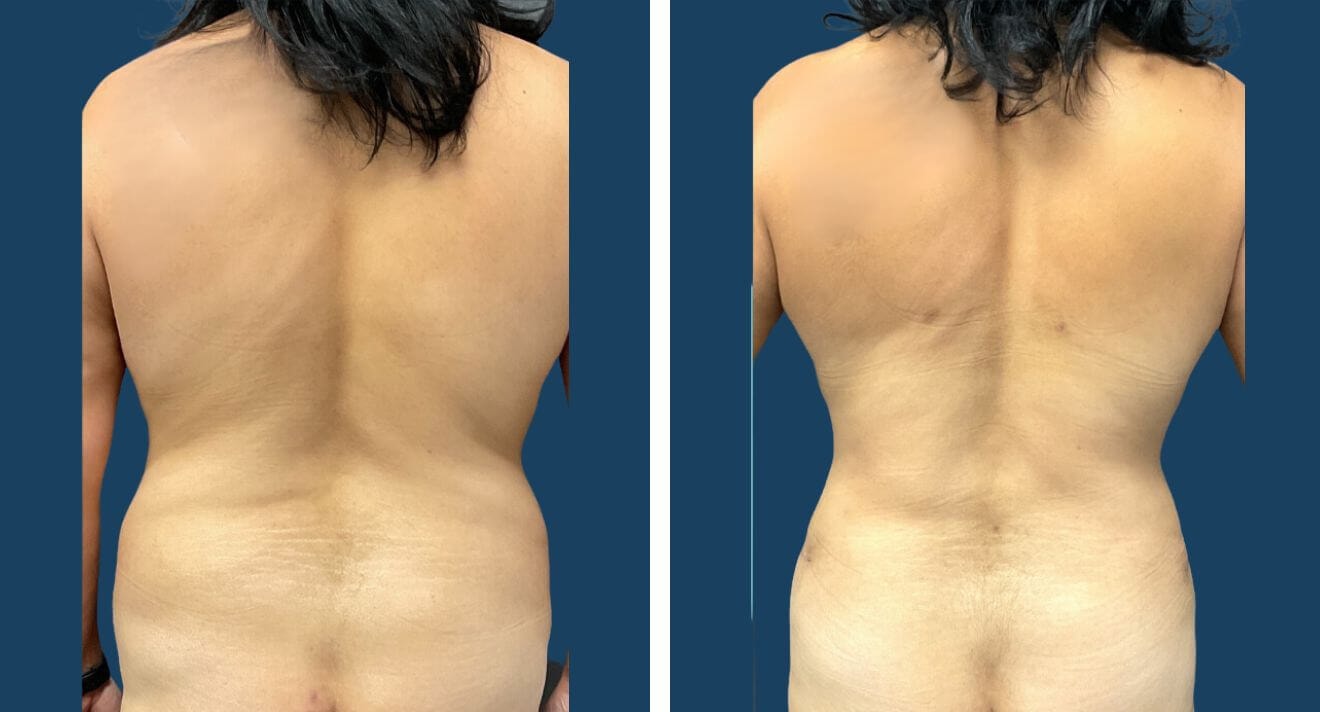 A result from Plano Plastic Surgery — MedSpa