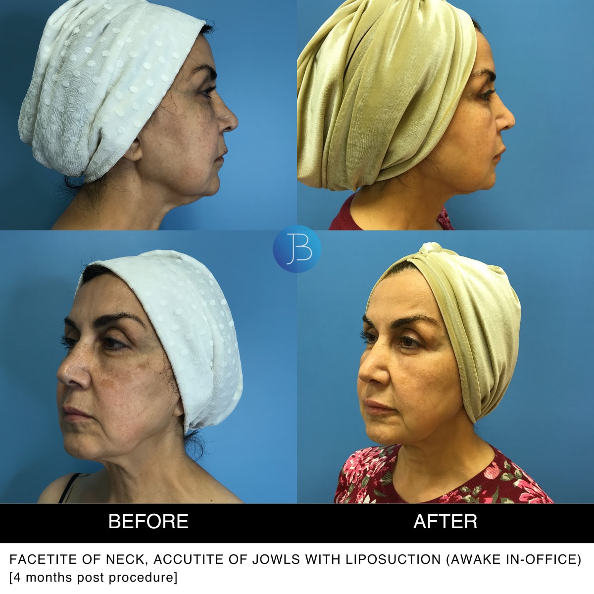 A result from Bloom Plastic Surgery