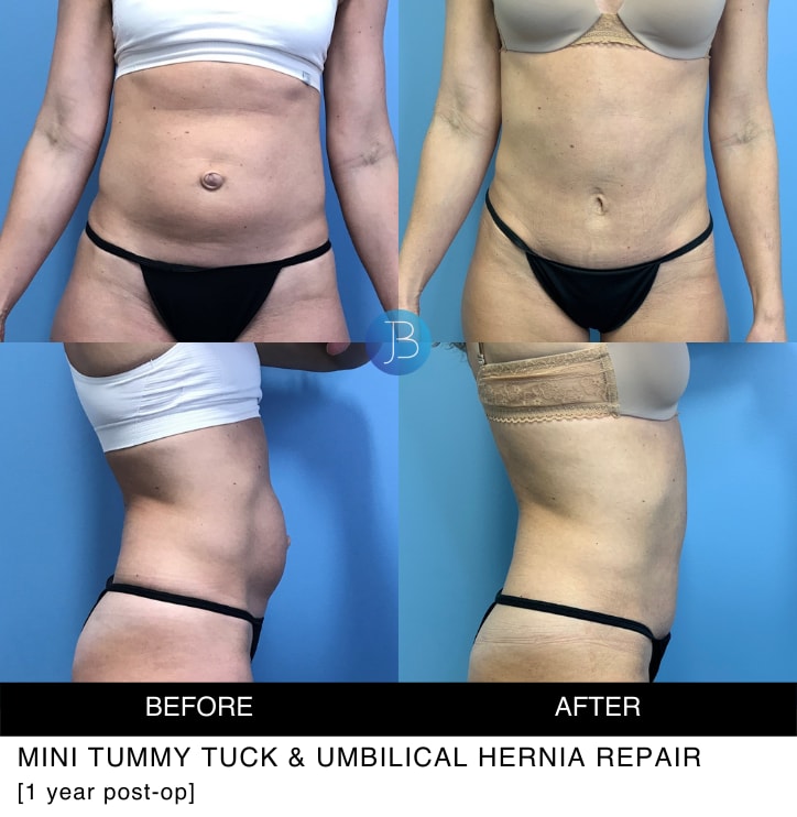 A result from Bloom Plastic Surgery