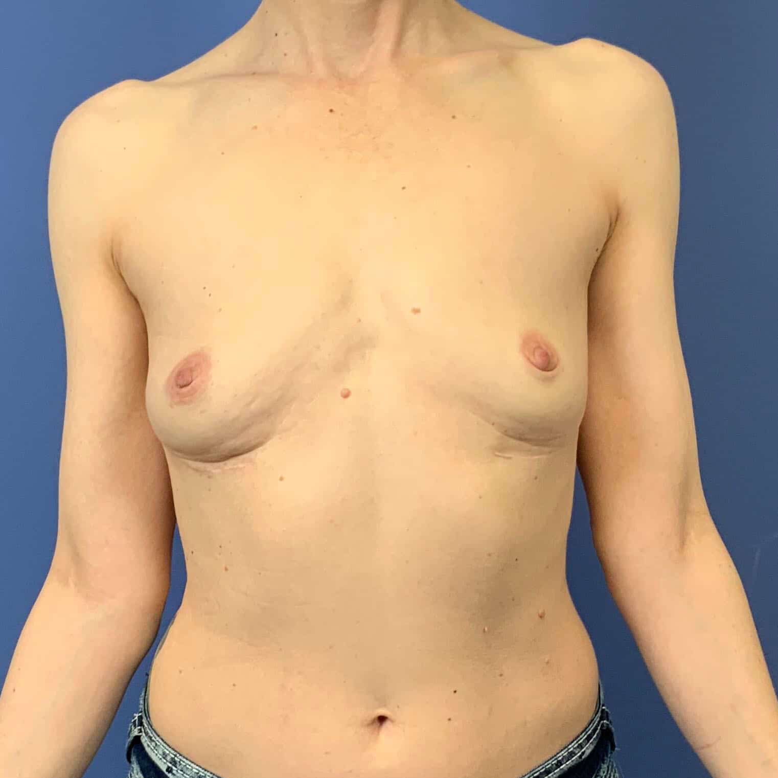 Breast Implant Removal result at Dr. York Yates Plastic Surgery