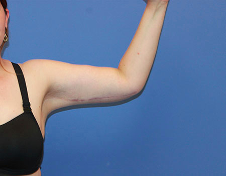 Arm Lift result at Dr. York Yates Plastic Surgery