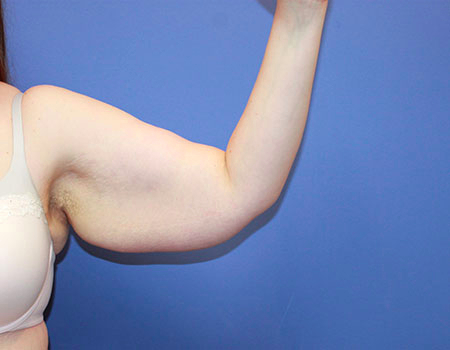 Arm Lift before photo