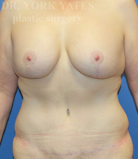 Body Contouring result at Dr. York Yates Plastic Surgery