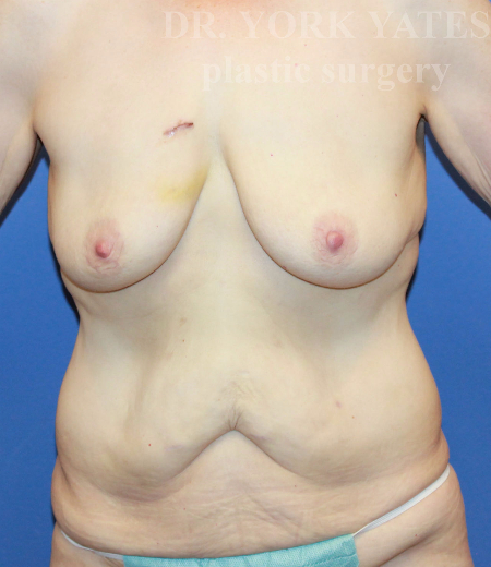 Body Contouring before photo