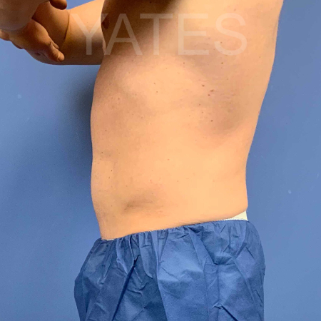 Dr. York Yates Plastic Surgery coolsculpting after — Tanner Clinic -Layton Parkway, UT