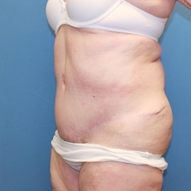 Body Contouring result at Dr. York Yates Plastic Surgery