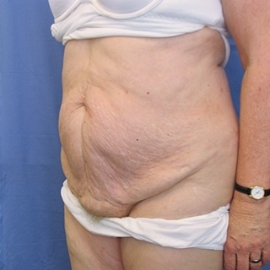 Body Contouring before photo