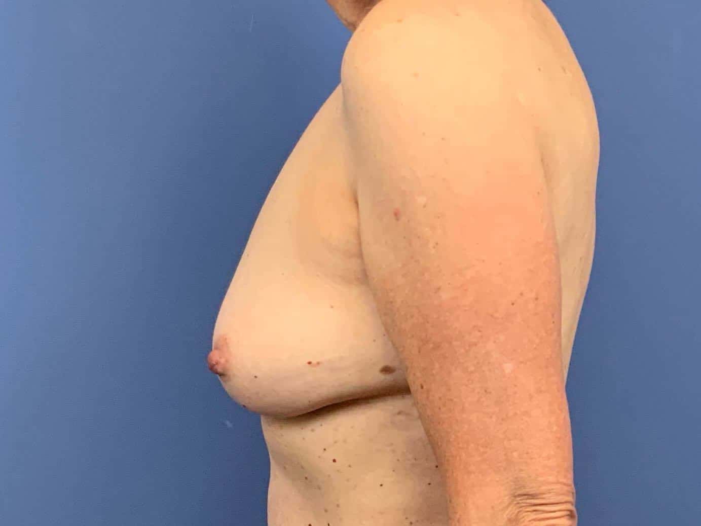 Breast Fat Transfer result at Dr. York Yates Plastic Surgery