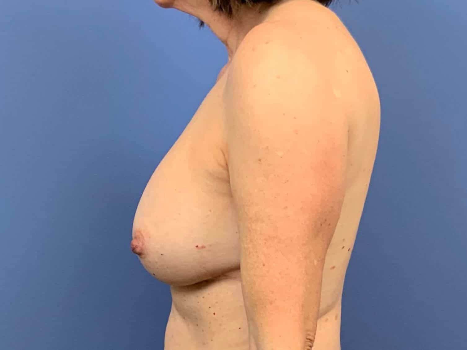 Breast Fat Transfer before photo