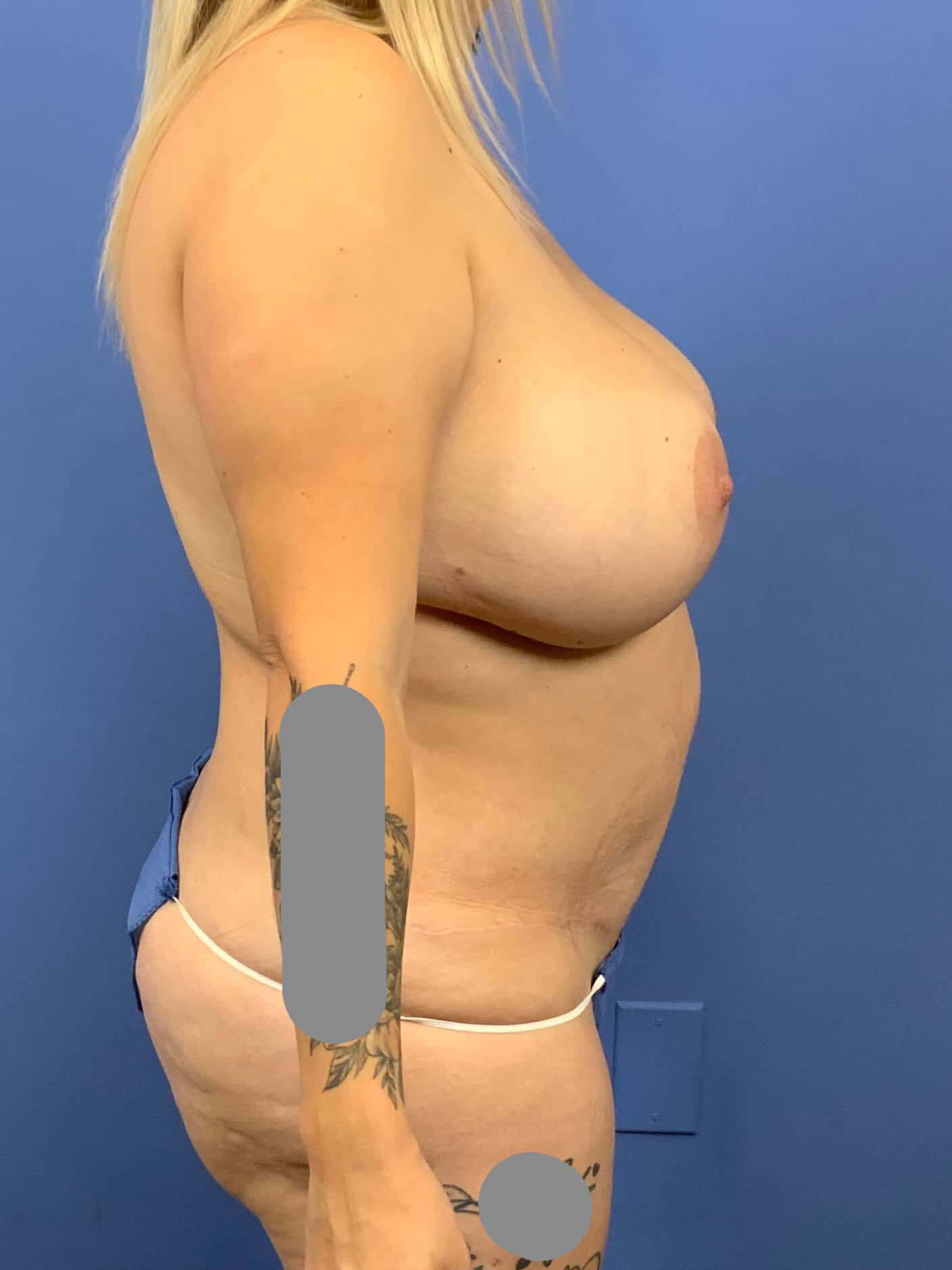 Breast Lift result at Dr. York Yates Plastic Surgery