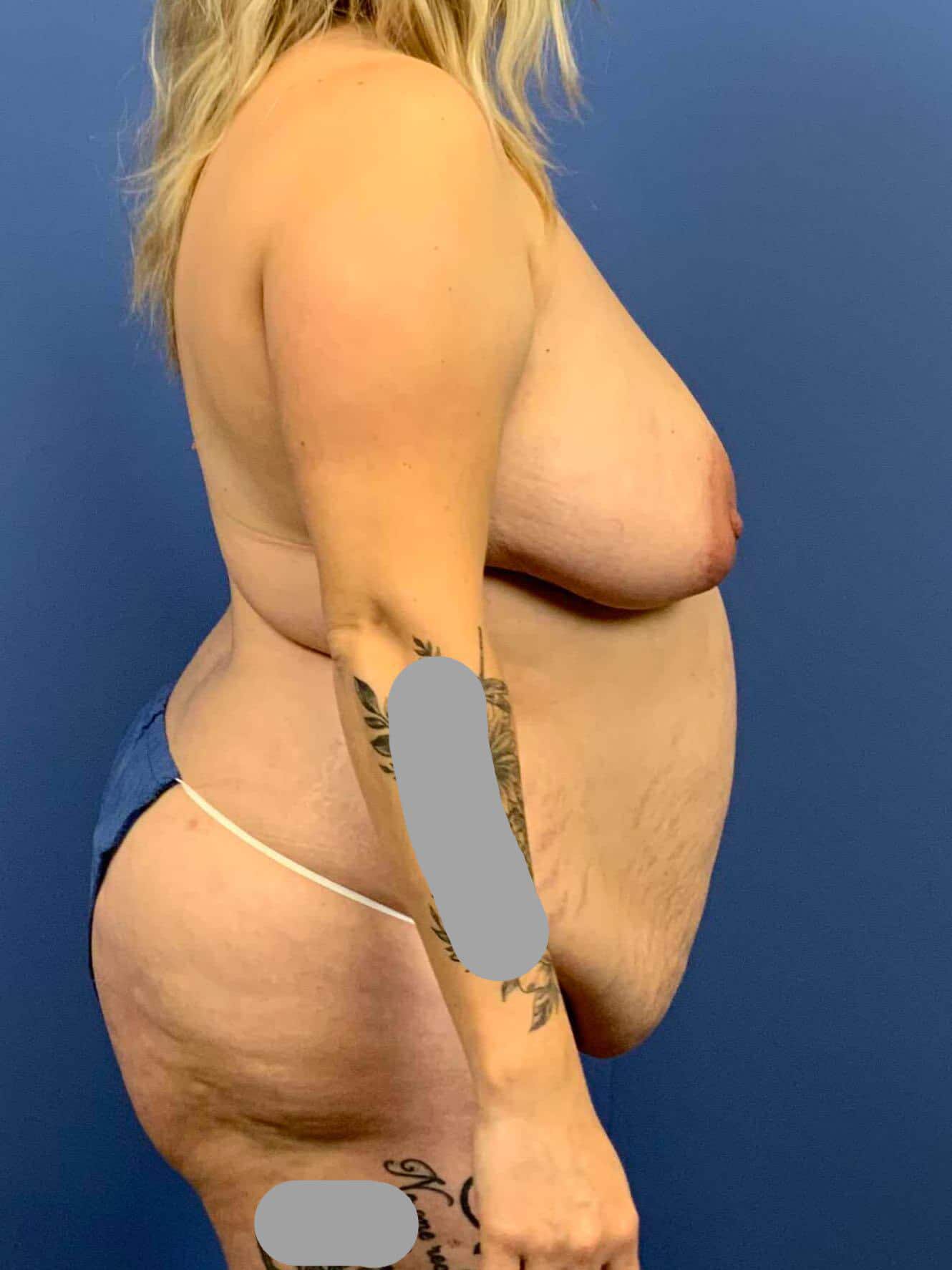 Breast Lift before photo