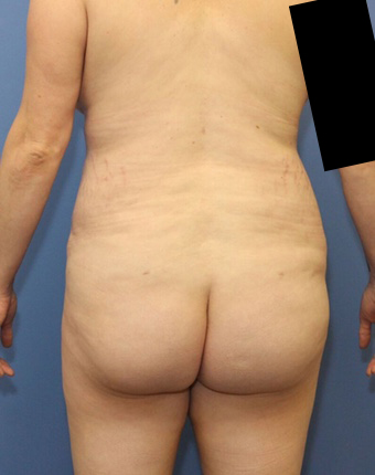 Dr. York Yates Plastic Surgery bbl after — Tanner Clinic -Layton Parkway, UT