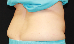 Dr. York Yates Plastic Surgery coolsculpting after — Tanner Clinic -Layton Parkway, UT
