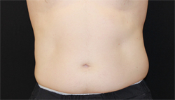Coolsculpting result at Dr. York Yates Plastic Surgery