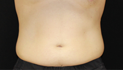 Coolsculpting before photo