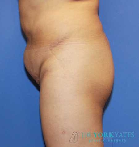 Liposuction before photo