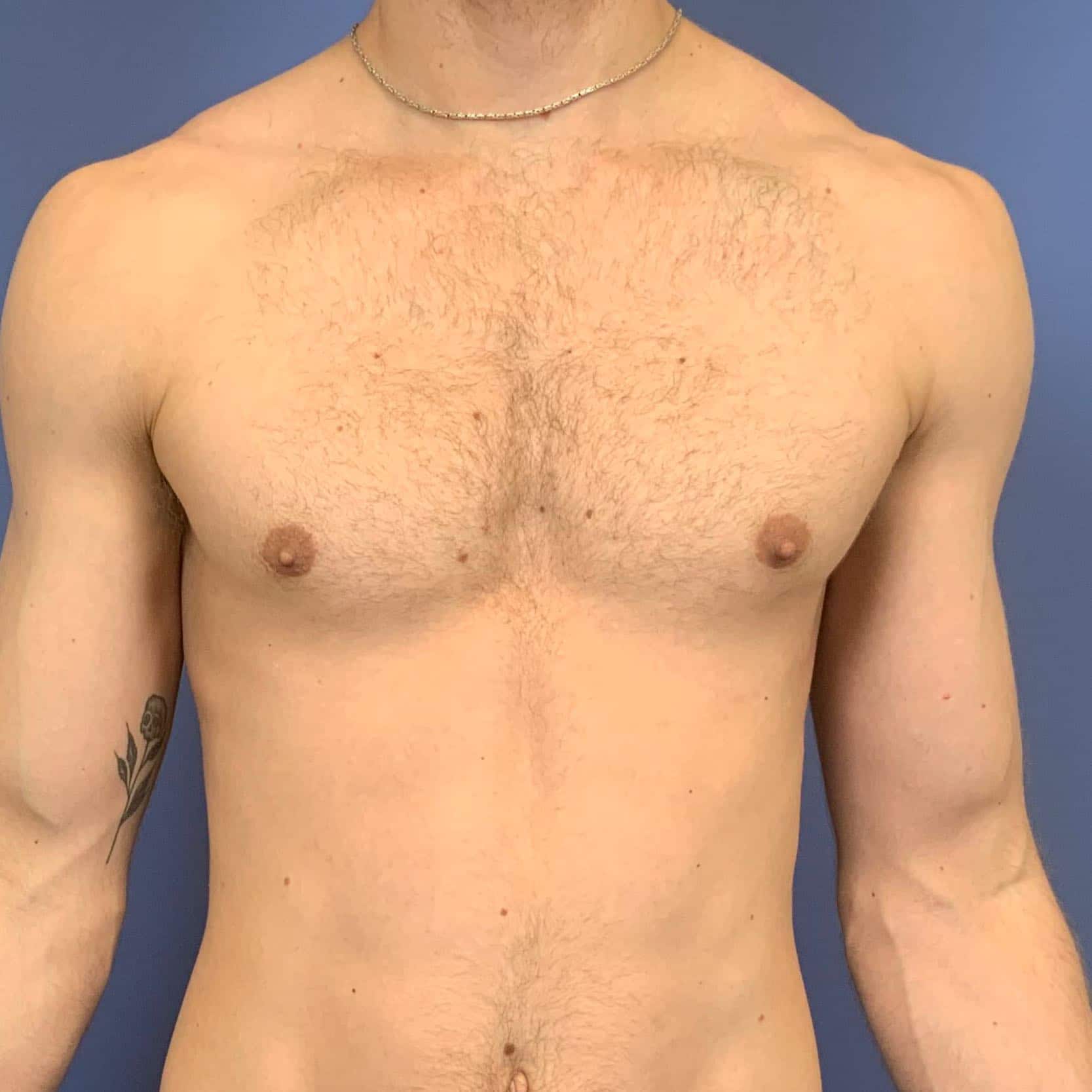 Gynecomastia result at Dr. York Yates Plastic Surgery