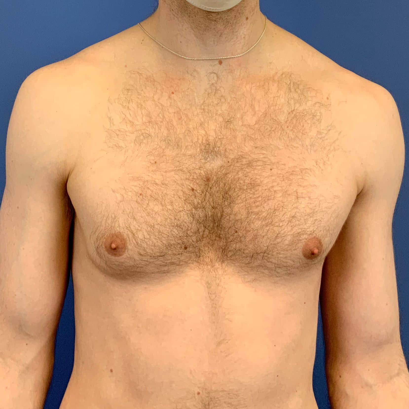 Gynecomastia before photo