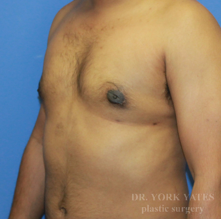 Gynecomastia result at Dr. York Yates Plastic Surgery
